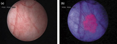 Blue Light Cytoscopy
