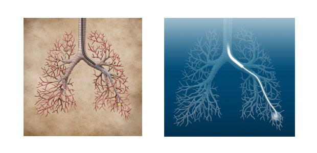 Electromagnetic Navigation Bronchoscope