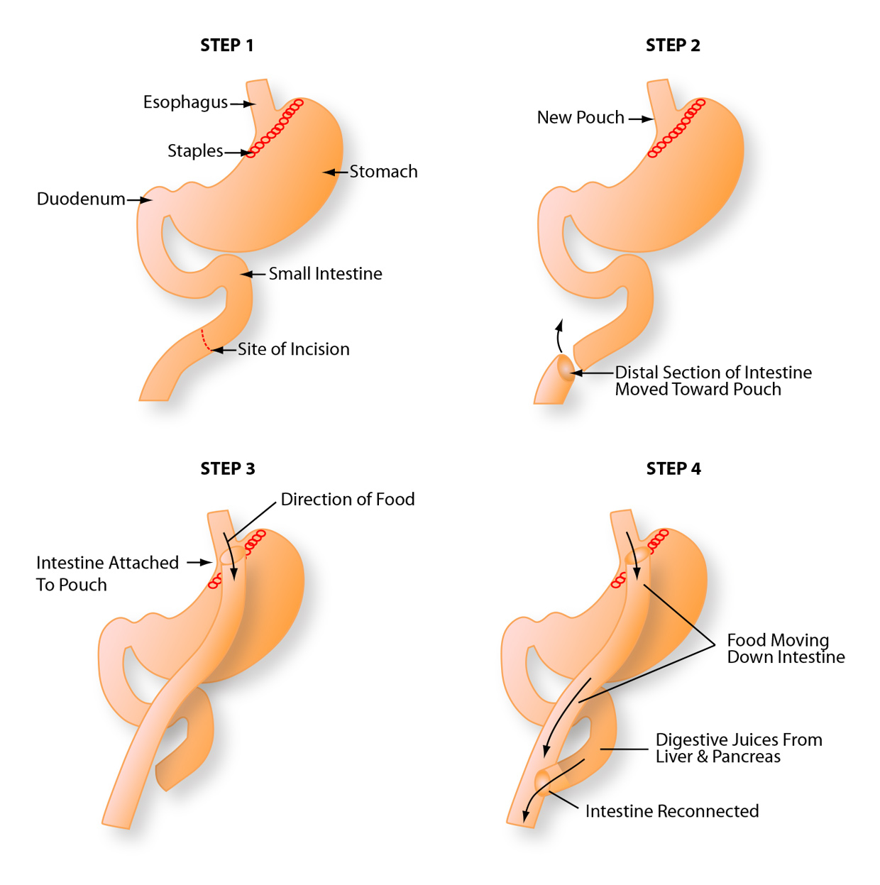 Gastric Bypass Surgery