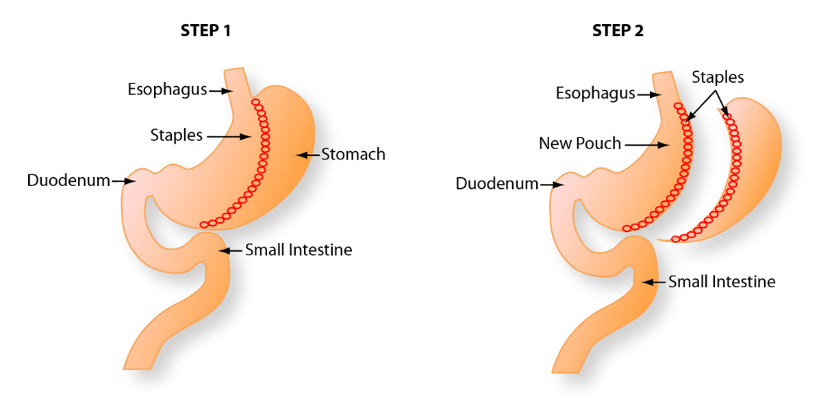 Gastric Sleeve Surgery