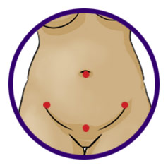 Laparoscopic Surgery Scars