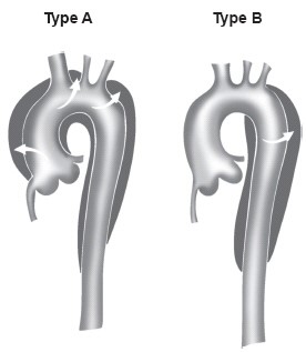 stanford-aortic-dissection