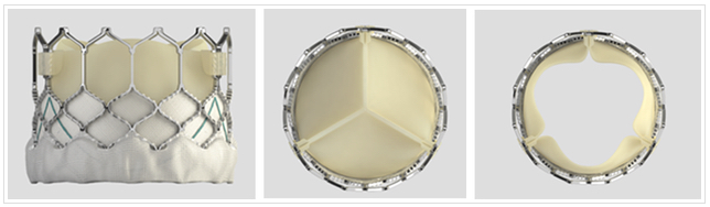 Image of the the artificial valve that may be inserted through an artery in the leg to the diseased aortic valve during a TAVR procedure.
