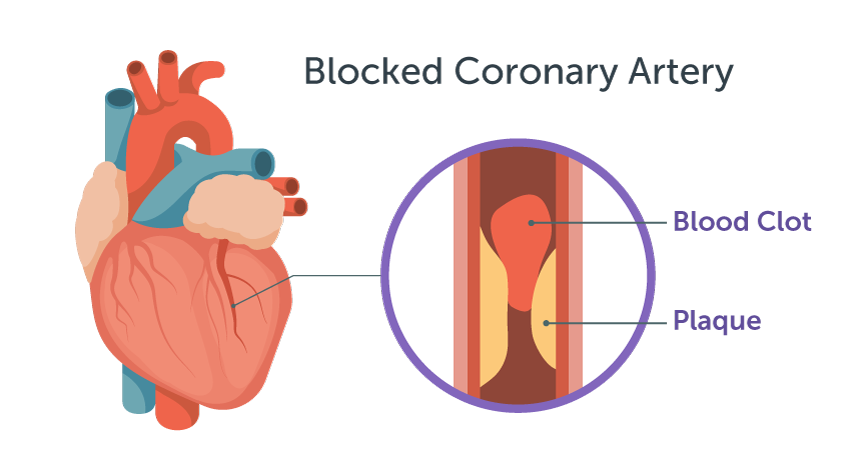 Blocked Coronary Artery