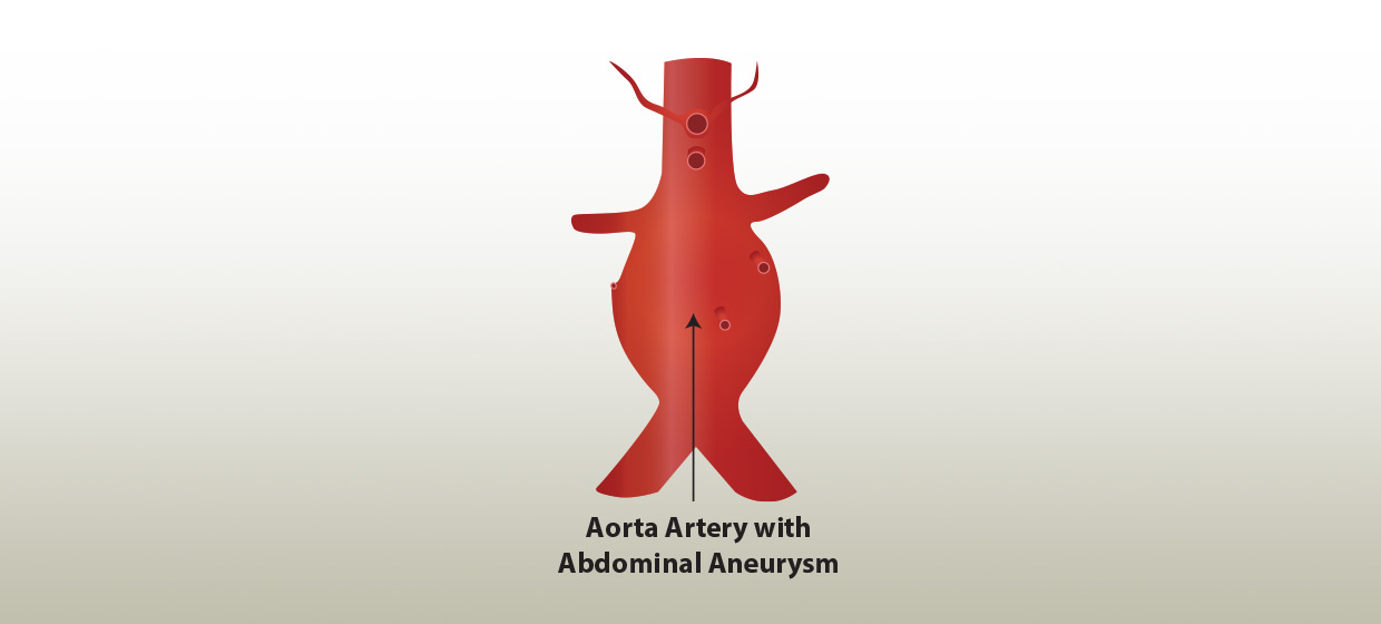 Aortic Aneurysm