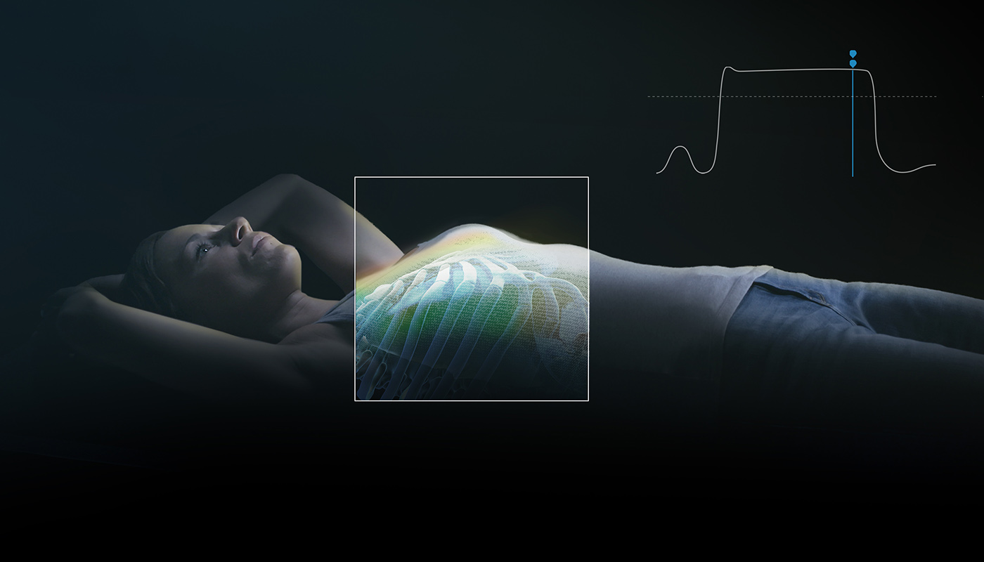 Brainlab ExacTrac Dynamic DIBH Breast with Breathing Curve