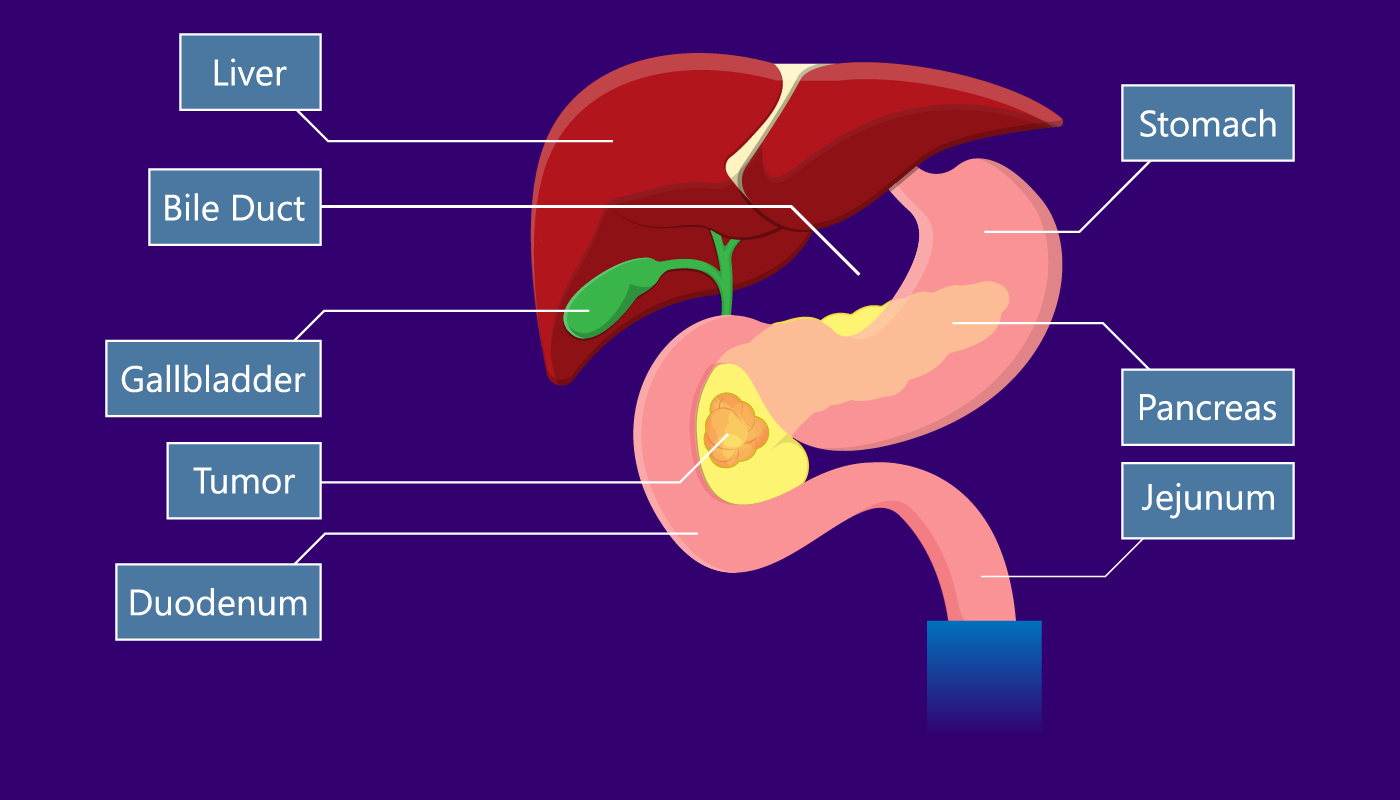 Whipple procedure (pancreaticoduodenectomy) - Step-1