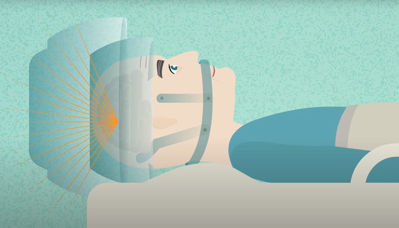 What is Insightec Focused Ultrasound Treatment video